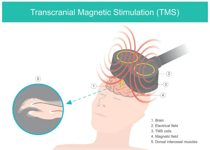 Transcranial Magnetic Stimulation (TMS) illustration